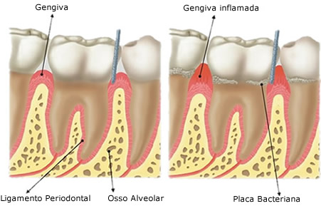 gengiva inflamada