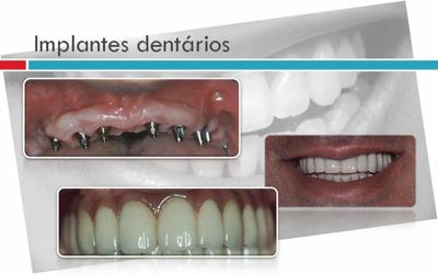 Implates dentários