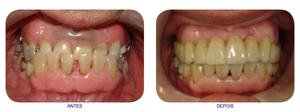 Reabilitação Bucal com Prótese